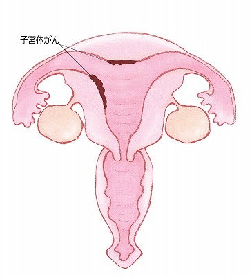 子宮体がん